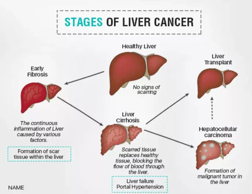Liver Cancer